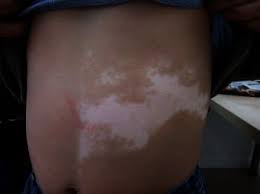 Maybe you would like to learn more about one of these? Vitiligo Erkrankungen Der Haut Msd Manual Profi Ausgabe