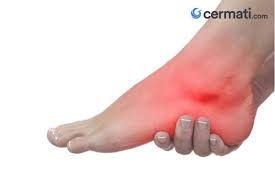 Sakit kaki karena kelebihan asam urat ( hiperurisemia ). Kaki Pegal Pegal Ini Cara Mengatasinya Cermati Com