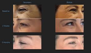 How long after botox injections on the forhead does it take to actually work? We Re Boxing Out Crows Feet The Results