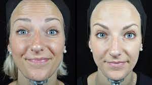 The New Baby Botox This Is Exactly What Happens To Your Face Healthista