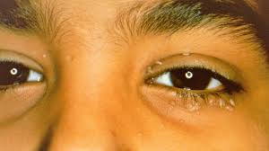 Image result for verrucae filiformes