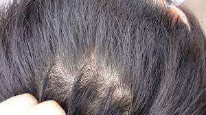 Follow these simple tips and get rid of dandruff permanently. How To Get Rid Of Dandruff From Camphor Coconut Oil Mix To Curd Natural Home Remedies To Get Dandruff Free Long Hair Fresh Headline