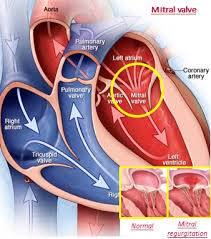 Mitral Valve Disease Medtentia