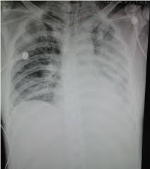 It is also widely available. Chest X Ray Film Of The Patient With Pneumonia Caused By Avian Download Scientific Diagram