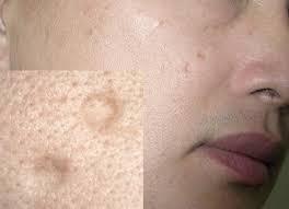 Rawatan Chickenpox Aura Ummi