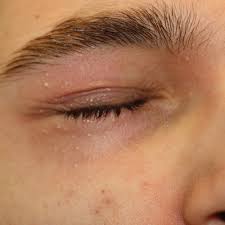 Image result for milium cyst on eyelid