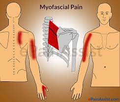 Myofascial Pain Syndrome Diet Skeletal Muscle Fatigue Causes