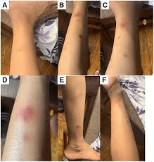 Image result for Panniculitis