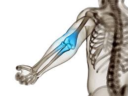 Die ursache kann auf das ellenbogengelenk, seine sehnen, muskeln und bänder, aber auch den bereich des. Arthritis Im Ellenbogengelenk Ursachen Symptome Behandlung