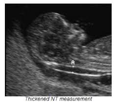 What is the 12 week nt. 12 Week Scan So Gi Scan