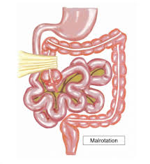 Image result for Intestinal Malrotation