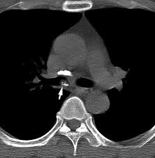 Image result for Broncholithiasis