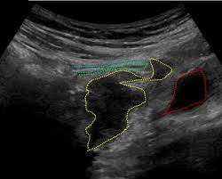 Maybe you would like to learn more about one of these? Intraoperative Deep Pelvic Ultrasound For Detection Of Ileocecal Endometriosis Journal Of Minimally Invasive Gynecology