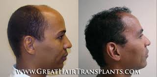 Best Hair Restoration Doctors For Men And Women in Alabama Marion Wiginton