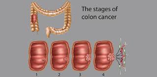 You think you know the american robin, but why are their eggs blue? Colon Cancer Quiz Trivia Questions Proprofs Quiz