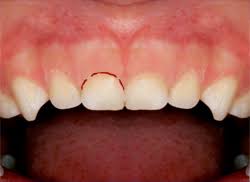 Image result for Tooth Luxation