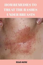 Image result for heat rash under breasts