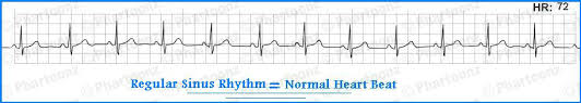 How To Read Ecg Basic Common Charts Phartoonz