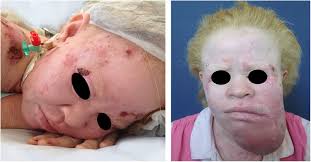There are graphic photos of skin cancer in. Morbimortality Associated With Skin Cancer Young Albino Patient Download Scientific Diagram