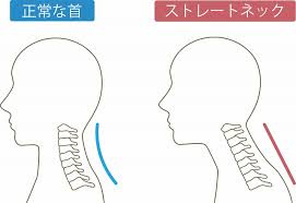 スマホ首・ストレートネックは寝て治せる？低い枕がいい？｜枚方市駅前やました整形外科リハビリテーション｜枚方市