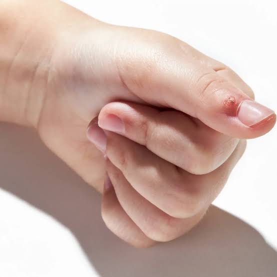 Wart Removal in Metro Atlanta | Goodman Dermatology