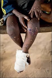 Monkeypox belongs to the same family of viruses as smallpox. Monkeypox Contacts A Puzzling Problem The Lancet