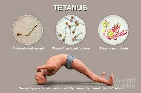Image result for Tetanus
