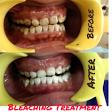 Teeth Whitening / Bleaching in Best Dental Clinic near me product image