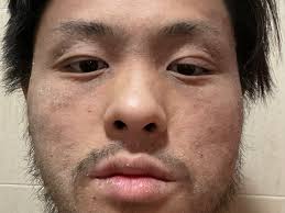 Fundraiser by Kevin He : Support Kevin's CAP Treatment for TSW Recovery