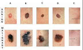 Some types of skin cancer are more dangerous than others, but if you have a spot. Bluescan Ai Skin Cancer Screening