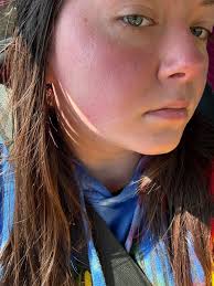 Possible medical causes of red cheeks in babies