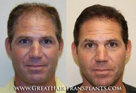 Hair Problems And Treatment For Men And Women in South Carolina Horry Conway