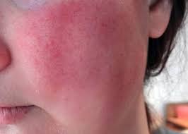 9 Nguyên nhân khiến da mặt bị đỏ ửng cần khắc phục - VIETSKIN