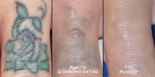 When you got your tattoo, you were younger and more impulsive. 45 Tattoo Removal Surrey