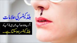 Symptoms, diagnosis and treatment • a type of cancer that starts in the bone marrow, where blood is produced • symptoms include fever, chills, fatigue, weakness, weight loss, bone and joint pain, anemia • treatments include chemotherapy, radiation, stem cell transplant, surgery, immunotherapy Blood Cancer Causes Symptoms Treatment In Urdu Hindi Ø¨Ù„Úˆ Ú©ÛŒÙ†Ø³Ø± Ú©Ø§ Ø¹Ù„Ø§Ø¬ Youtube