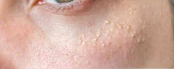 We did not find results for: 4 Ursachen Fur Weisse Flecken Oder Gesichtsflecken Im Gesicht Gesundheitsinformationen Medizinische Tipps Und Nutzliche Gesundheitsinformationen