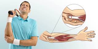 De tennisarm kan een chronische vorm aannemen waardoor de klachten maanden tot jaren kunnen aanhouden. Ellenbogenchirurgie