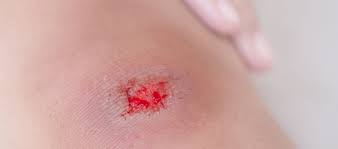 Such reactions can cause damage to the body tissues and vital organs. Blood Poisoning Naturopathic Doctor News And Review