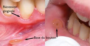La prononciation même varie selon le style. Piercing De La Langue Dr Sylvain Chamberland Orthodontiste