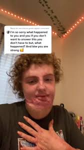 What Happened to Iris Burn Survivor