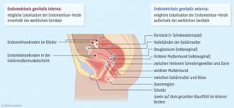 An endometriosis cyst on an ovary (endometrioma). Pharmakotherapie Der Endometriose