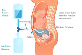 Check spelling or type a new query. Apakah Itu Dialisis Peritoneal The National Kidney Foundation Nkf Singapore