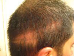 It is important to note that hair shedding after a hair transplant is a normal occurrence and is the body's way of responding to the trauma it received during the hair transplant procedure. What Is The Shock Loss After A Hair Transplant Clinicana