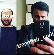 Trend Hair Corlu Sac Ekimi Sac Ektirme Corlu Cerkezkoy Sakal Biyik Fue Teknigi Biyiklar Trendler Cilt Urunleri