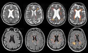 Image result for Brain Lesion