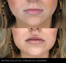 Before and After Photos of Fillers in Nashville
