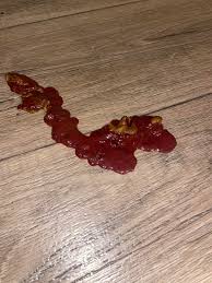 Image result for blood in stool human poop