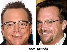 19 Celebrities Who Probably Have Had Hair Transplants Hair Transplant Surgery Hair Transplant Laser Hair Removal