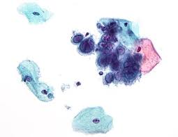 Image result for Herpes Simplex Virus Testing