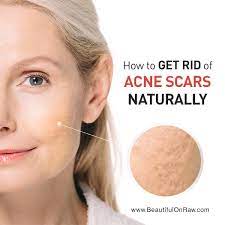Are you struggling with acne or acne scaring? How To Get Rid Of Acne Scars Naturally Beautiful On Raw